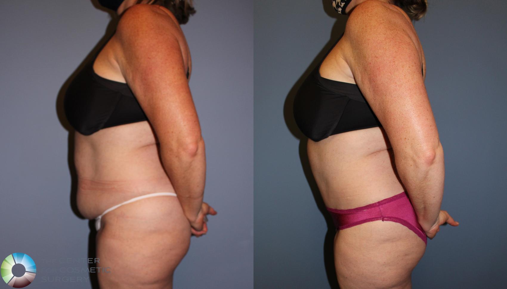 Before & After Tummy Tuck Case 11771 Left Side in Denver and Colorado Springs, CO