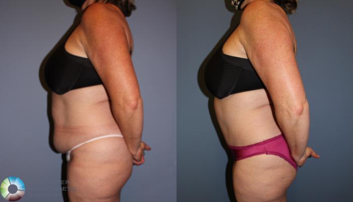 Before & After Tummy Tuck Case 11771 Left Side View in Golden, CO