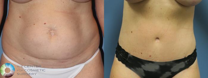 Before & After Tummy Tuck Case 11781 Front View in Golden, CO
