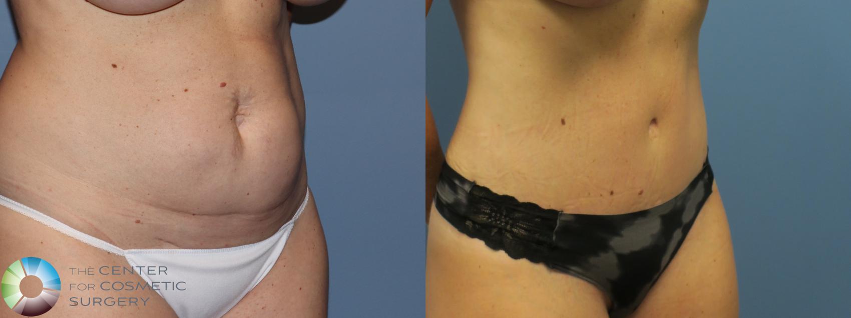 Before & After Tummy Tuck Case 11781 Left Oblique View in Golden, CO