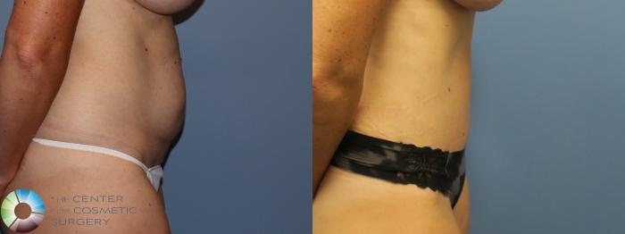 Before & After Tummy Tuck Case 11781 Right Side View in Golden, CO
