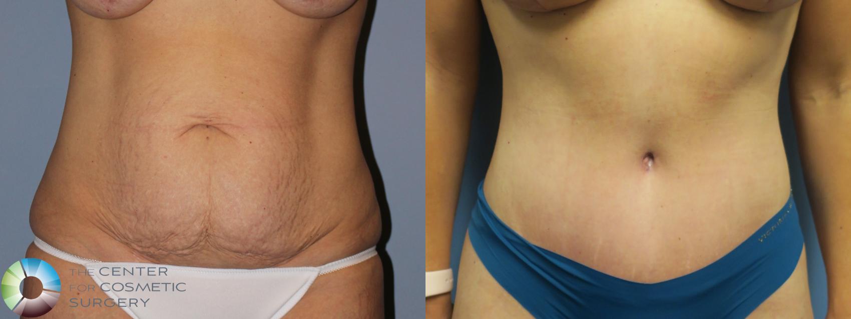 Before & After Tummy Tuck Case 11850 Front View in Golden, CO