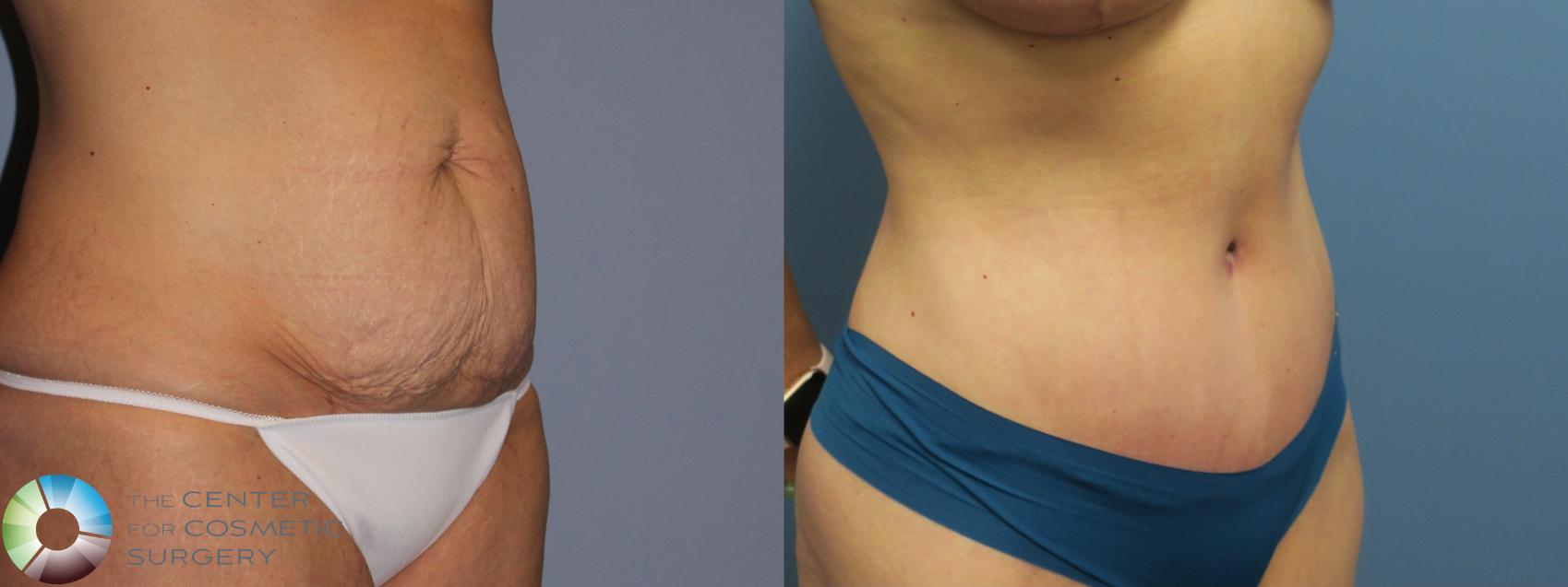 Before & After Tummy Tuck Case 11850 Right Oblique in Denver and Colorado Springs, CO