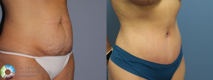 Before & After Tummy Tuck Case 11850 Right Oblique View in Golden, CO