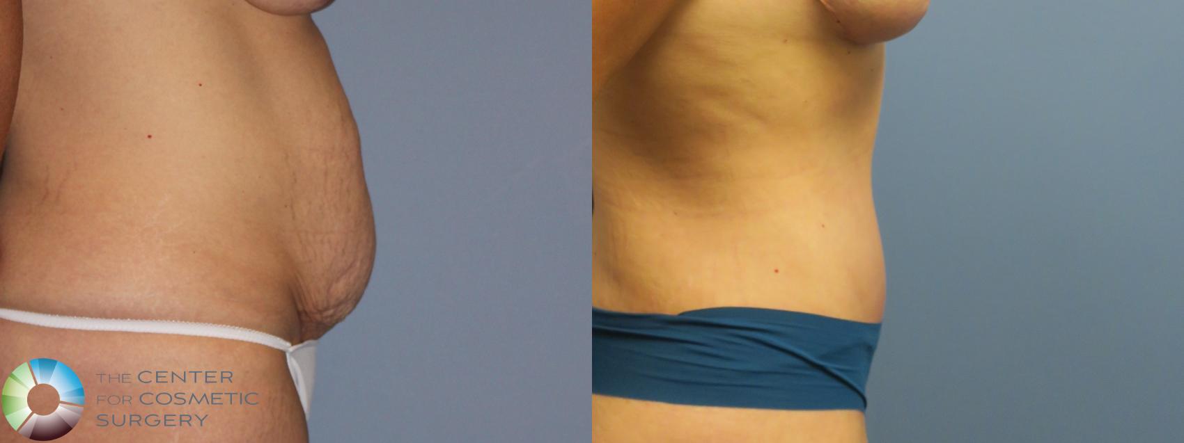 Before & After Tummy Tuck Case 11850 Right Side in Denver and Colorado Springs, CO