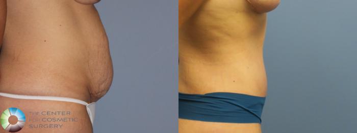 Before & After Tummy Tuck Case 11850 Right Side View in Golden, CO