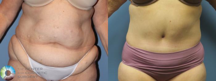 Before & After Tummy Tuck Case 11851 Front in Denver and Colorado Springs, CO