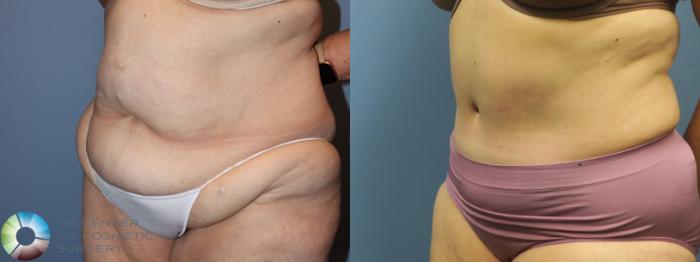 Before & After Tummy Tuck Case 11851 Left Oblique in Denver and Colorado Springs, CO