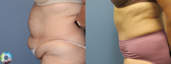 Before & After Tummy Tuck Case 11851 Left Side in Denver and Colorado Springs, CO