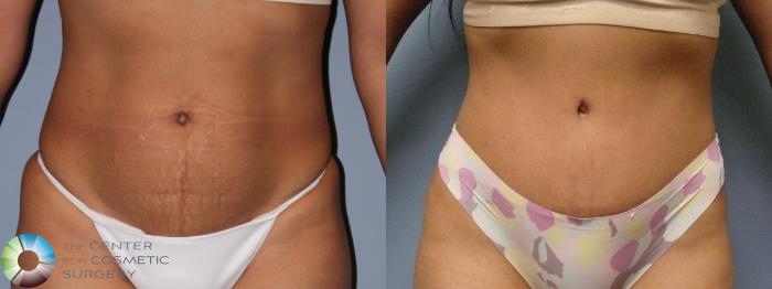 Before & After Tummy Tuck Case 11852 Front in Denver and Colorado Springs, CO