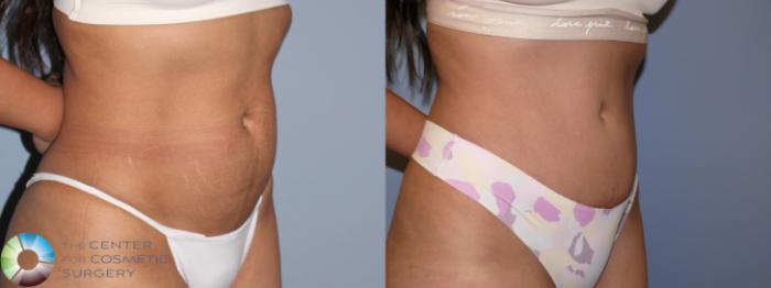 Before & After Tummy Tuck Case 11852 Right Oblique in Denver and Colorado Springs, CO