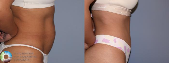 Before & After Tummy Tuck Case 11852 Right Side in Denver and Colorado Springs, CO