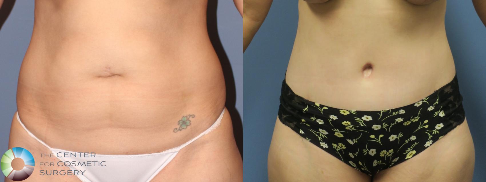Before & After Tummy Tuck Case 11853 Front in Denver and Colorado Springs, CO