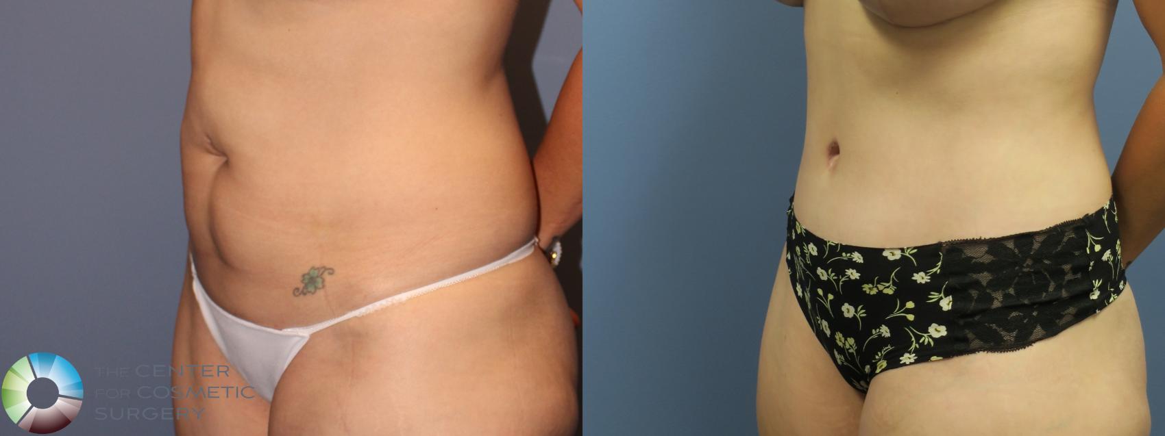 Before & After Tummy Tuck Case 11853 Left Oblique in Denver, CO