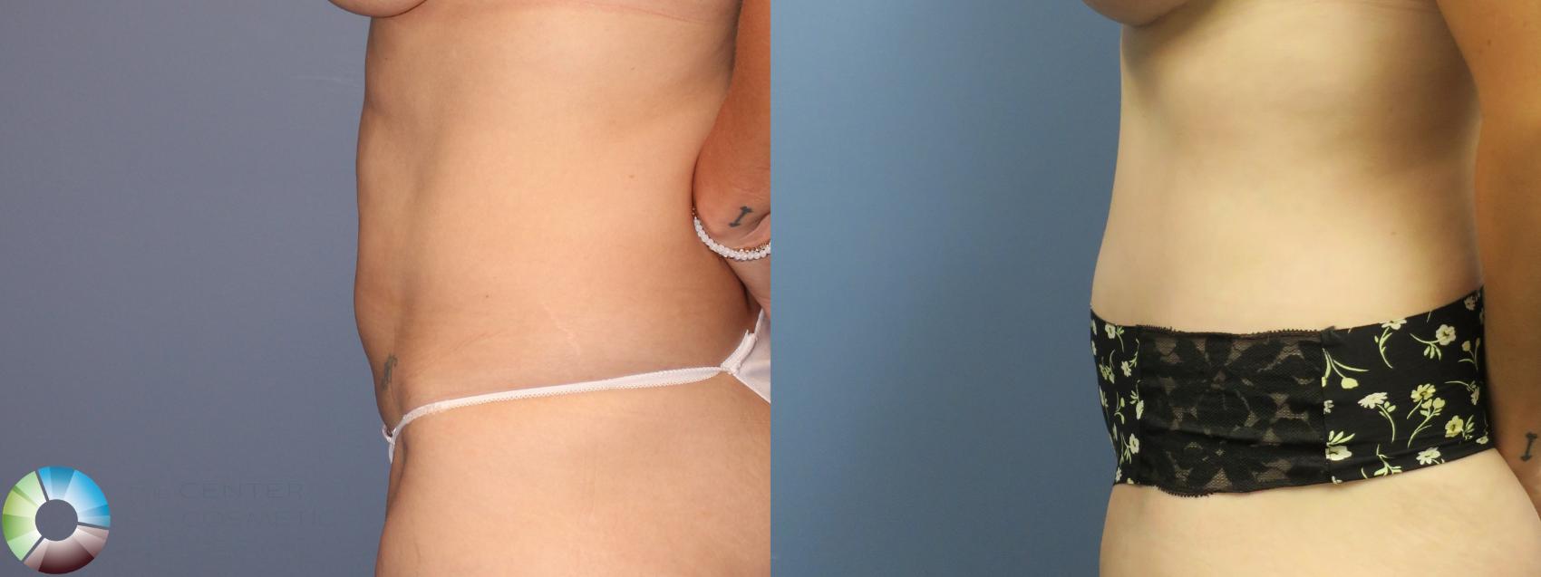 Before & After Tummy Tuck Case 11853 Left Side in Denver and Colorado Springs, CO
