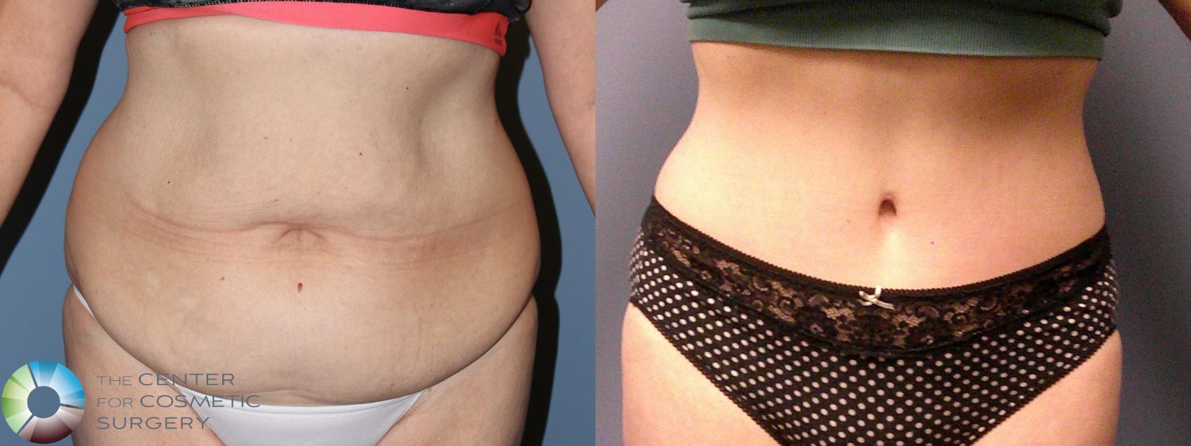 Before & After Tummy Tuck Case 11886 Front View in Golden, CO