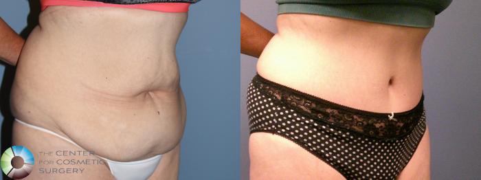 Before & After Tummy Tuck Case 11886 Right Oblique View in Golden, CO