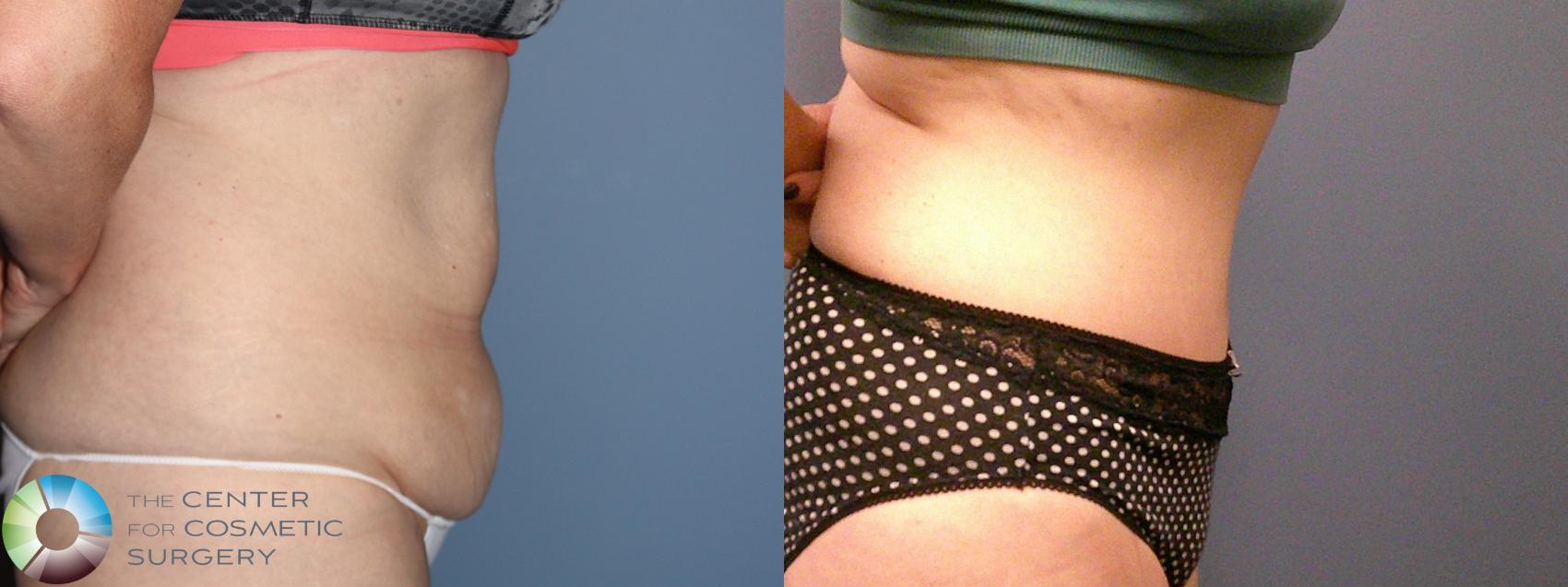 Before & After Tummy Tuck Case 11886 Right Side in Denver and Colorado Springs, CO