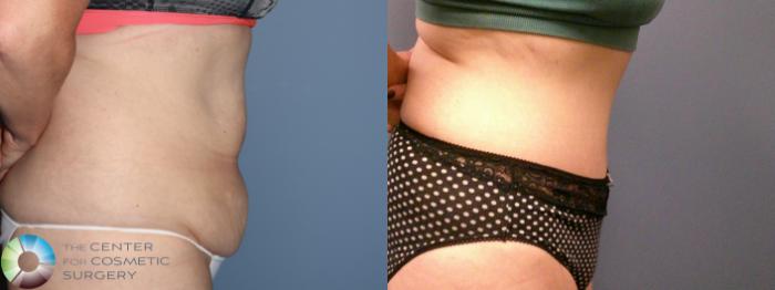 Before & After Tummy Tuck Case 11886 Right Side View in Golden, CO