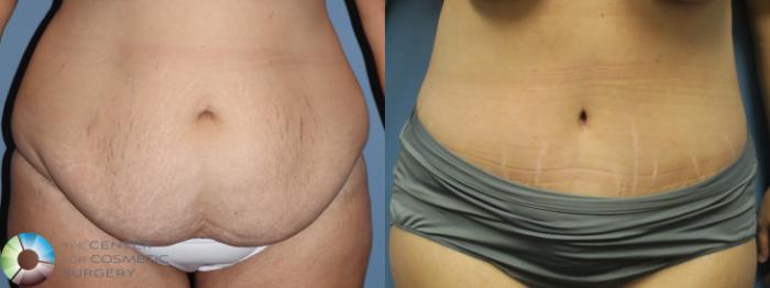 Before & After Tummy Tuck Case 11896 Front in Denver and Colorado Springs, CO
