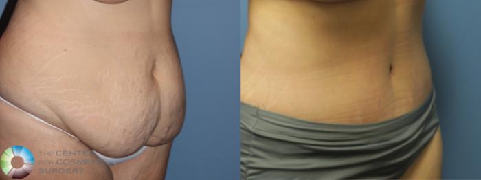 Before & After Tummy Tuck Case 11896 Right Oblique in Denver and Colorado Springs, CO