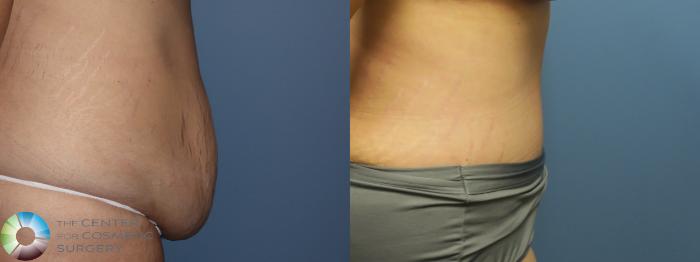 Before & After Tummy Tuck Case 11896 Right Side in Denver and Colorado Springs, CO