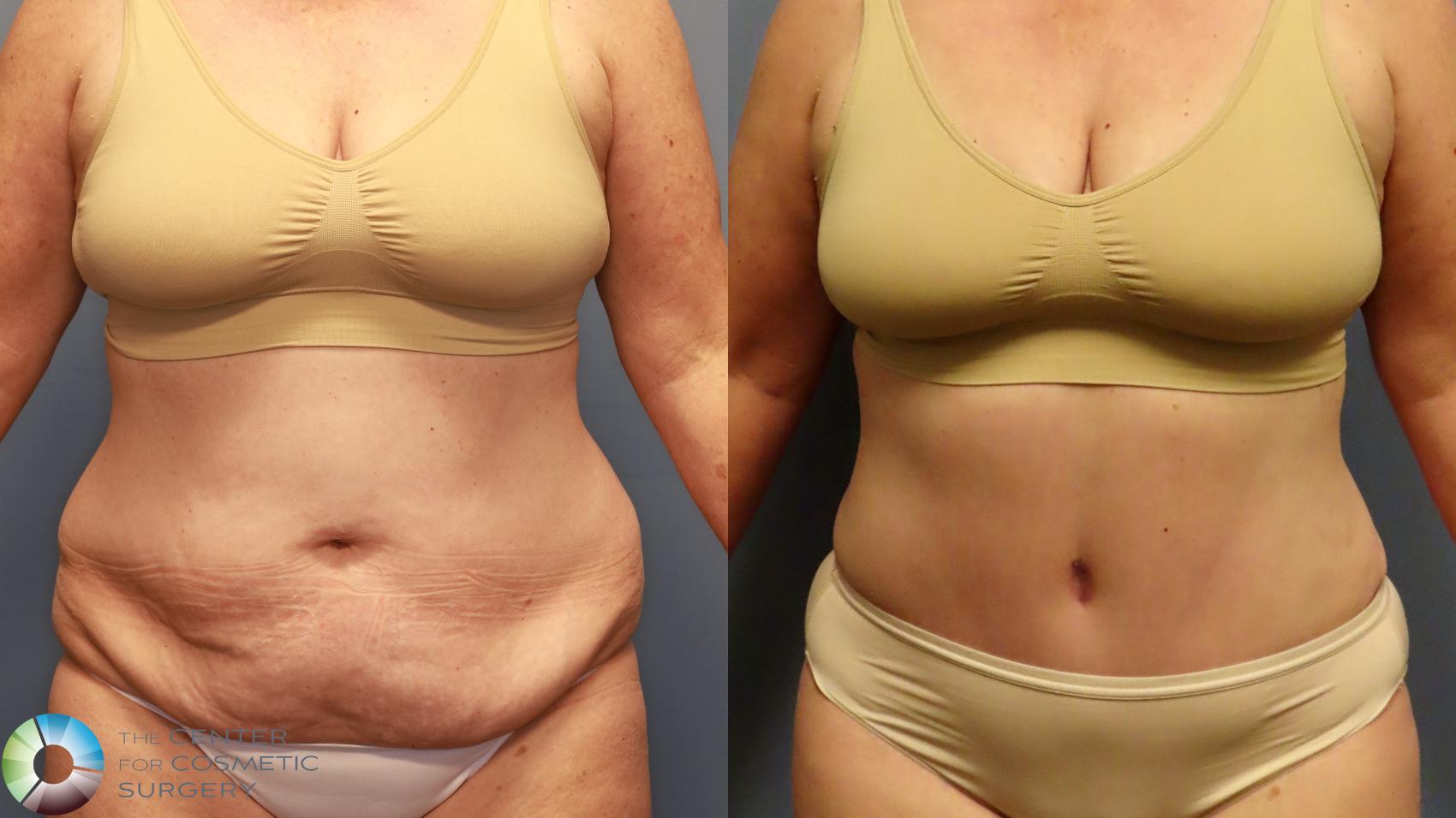 Before & After Tummy Tuck Case 11914 Front View in Golden, CO