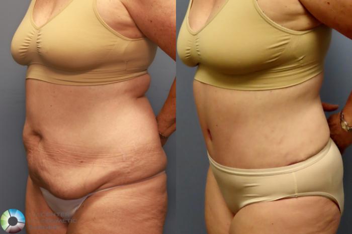 Before & After Tummy Tuck Case 11914 Left Oblique View in Golden, CO