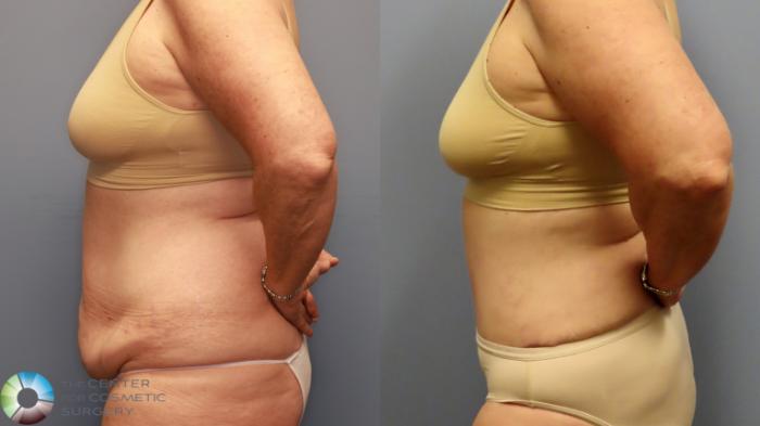 Before & After Tummy Tuck Case 11914 Left Side View in Golden, CO