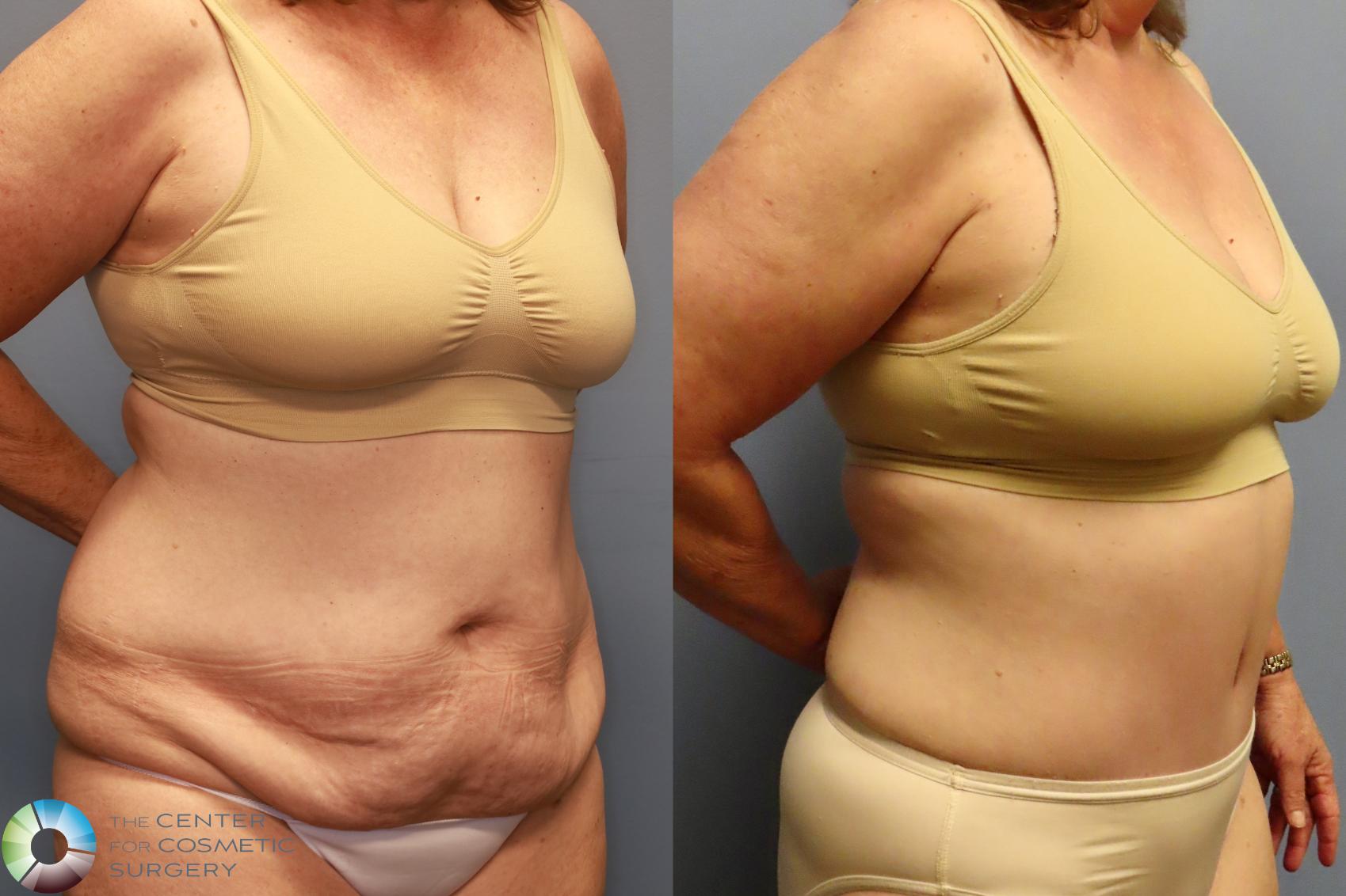 Before & After Tummy Tuck Case 11914 Right Oblique in Denver and Colorado Springs, CO