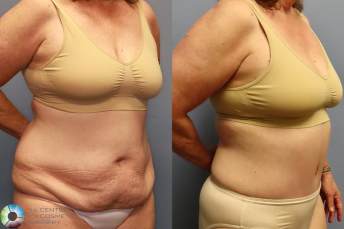 Before & After Tummy Tuck Case 11914 Right Oblique View in Golden, CO