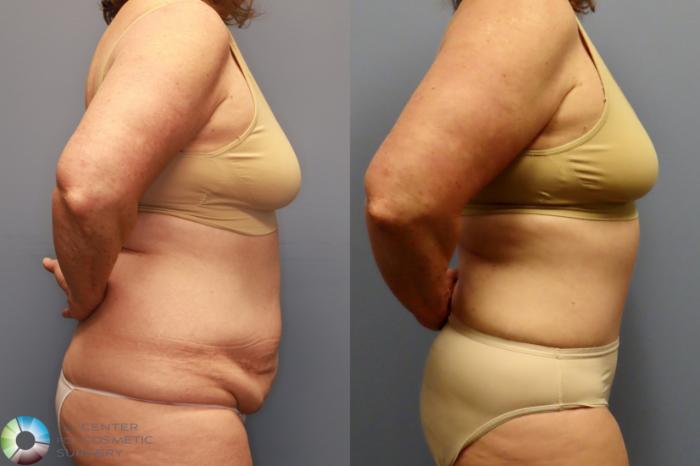 Before & After Tummy Tuck Case 11914 Right Side View in Golden, CO