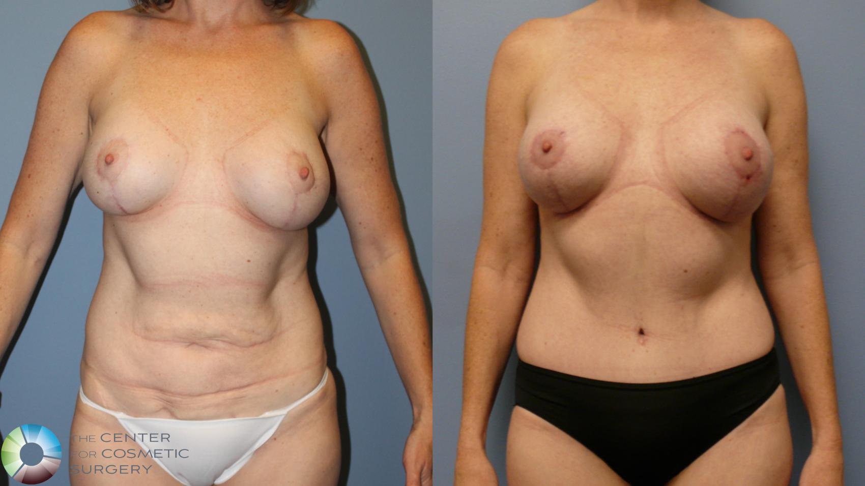 Before & After Mommy Makeover Case 11945 Front in Denver and Colorado Springs, CO