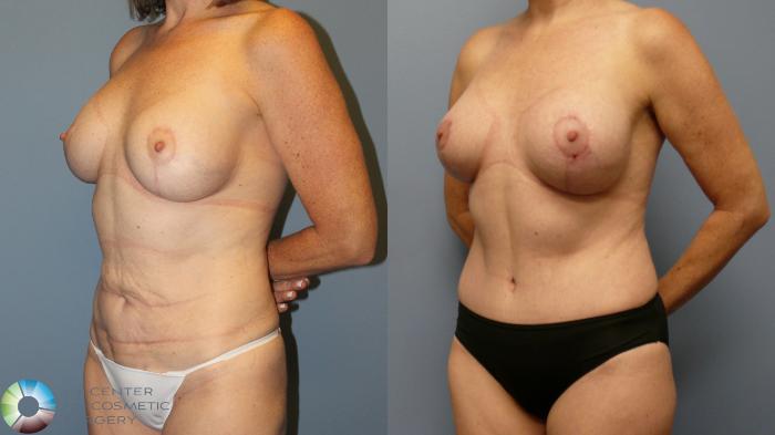 Before & After Breast Lift Case 11945 Left Oblique in Denver and Colorado Springs, CO