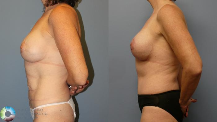 Before & After Breast Lift Case 11945 Left Side in Denver and Colorado Springs, CO
