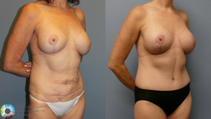 Before & After Breast Lift Case 11945 Right Oblique in Denver and Colorado Springs, CO