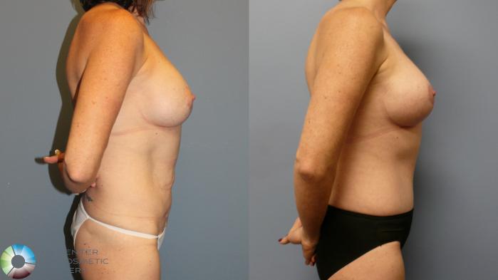 Before & After Tummy Tuck Case 11945 Right Side in Denver and Colorado Springs, CO