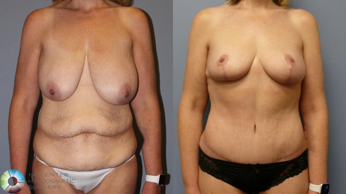 Before & After Breast Reduction Case 11977 Front in Denver and Colorado Springs, CO