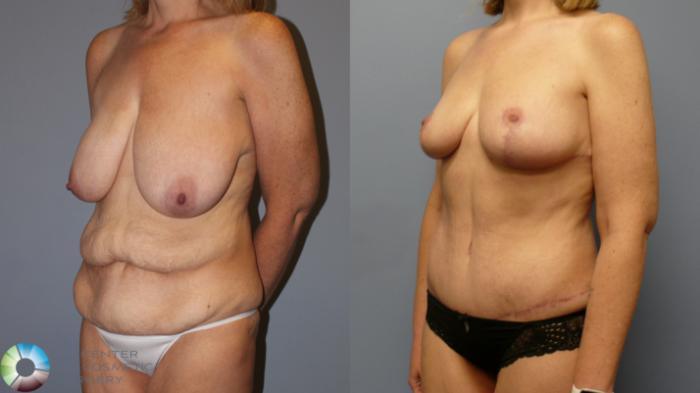 Before & After Breast Reduction Case 11977 Left Oblique in Denver and Colorado Springs, CO