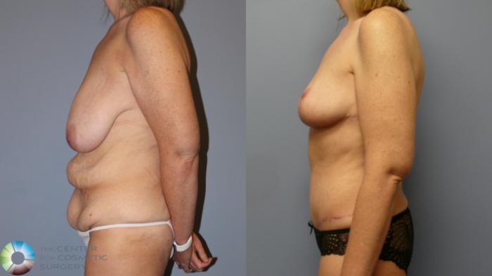 Before & After Breast Reduction Case 11977 Left Side in Denver and Colorado Springs, CO