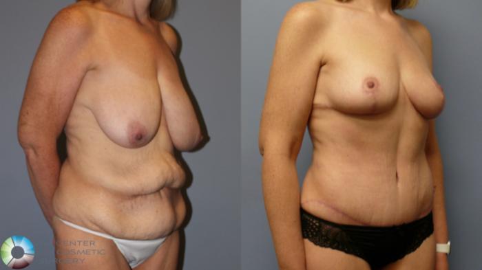 Before & After Breast Reduction Case 11977 Right Oblique in Denver and Colorado Springs, CO