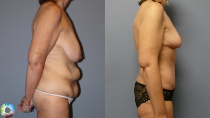 Before & After Tummy Tuck Case 11977 Right Side in Denver and Colorado Springs, CO