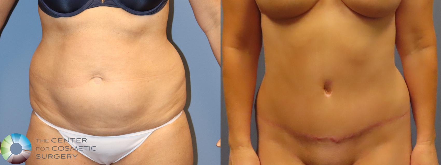 Before & After Tummy Tuck Case 11978 Front in Denver and Colorado Springs, CO