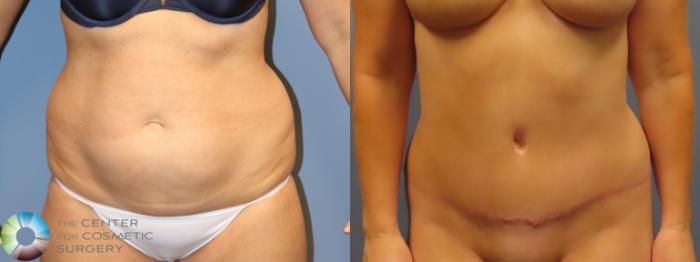 Before & After Tummy Tuck Case 11978 Front in Denver and Colorado Springs, CO