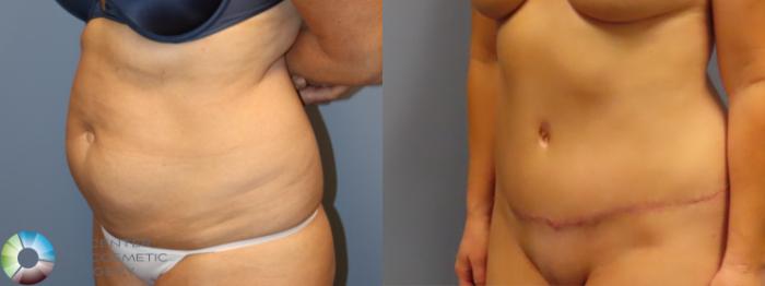 Before & After Tummy Tuck Case 11978 Left Oblique in Denver and Colorado Springs, CO