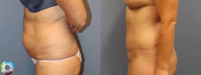 Before & After Tummy Tuck Case 11978 Left Side in Denver and Colorado Springs, CO