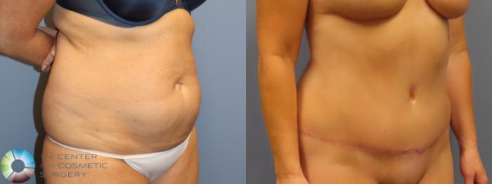Before & After Tummy Tuck Case 11978 Right Oblique in Denver and Colorado Springs, CO