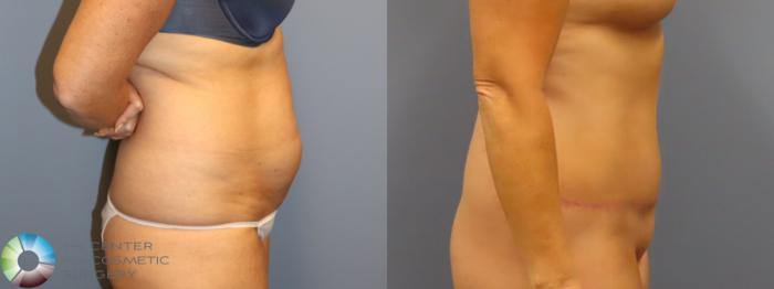 Before & After Tummy Tuck Case 11978 Right Side in Denver and Colorado Springs, CO
