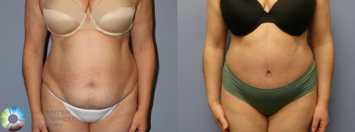 Before & After Tummy Tuck Case 11992 Front in Denver and Colorado Springs, CO