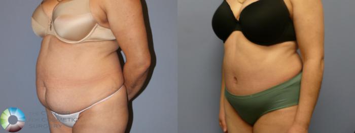 Before & After Tummy Tuck Case 11992 Left Oblique in Denver and Colorado Springs, CO